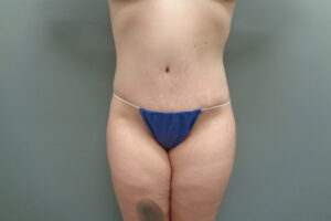 Before & After Pictures in Nashville, TN