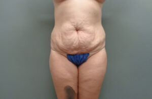 Before & After Pictures in Nashville, TN