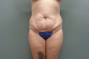 Before & After Pictures in Nashville, TN