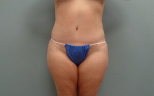 Before & After Pictures in Nashville, TN
