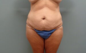 Before & After Pictures in Nashville, TN