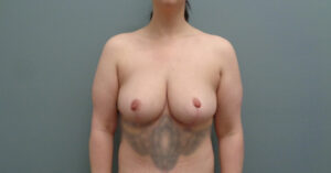 Before & After Pictures in Nashville, TN