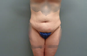 Before & After Pictures in Nashville, TN