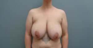 Before & After Pictures in Nashville, TN