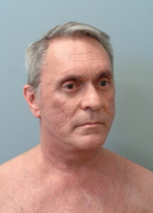 Before & After Pictures in Nashville, TN