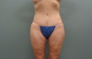 Before & After Pictures in Nashville, TN