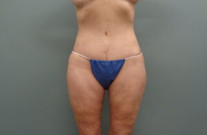Before & After Pictures in Nashville, TN