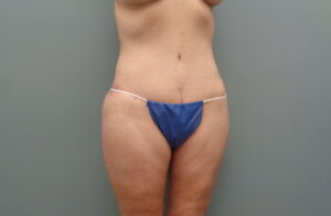 Before & After Pictures in Nashville, TN