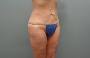 Before & After Pictures in Nashville, TN