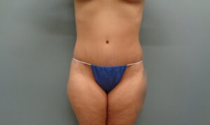 Before & After Pictures in Nashville, TN