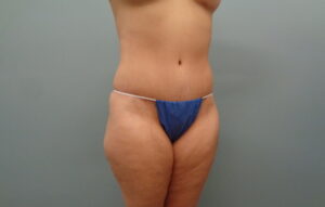 Before & After Pictures in Nashville, TN