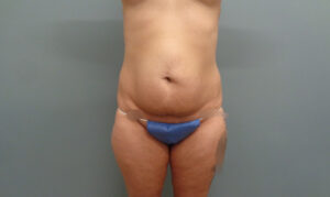 Before & After Pictures in Nashville, TN