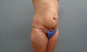 Before & After Pictures in Nashville, TN