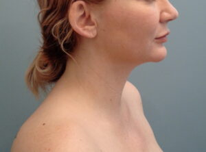 Before & After Pictures in Nashville, TN