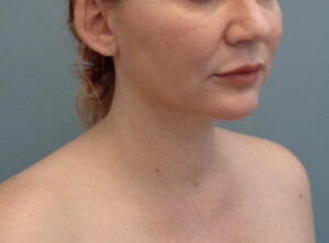 Before & After Pictures in Nashville, TN