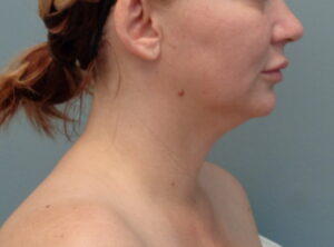 Before & After Pictures in Nashville, TN