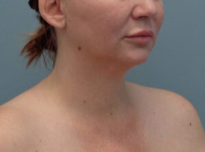 Before & After Pictures in Nashville, TN