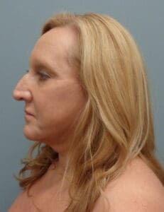 Before & After Pictures in Nashville, TN