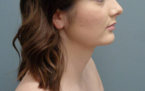 Before & After Pictures in Nashville, TN