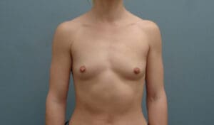 Before & After Pictures in Nashville, TN