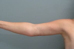 Before & After Pictures in Nashville, TN