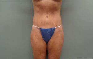 Before & After Pictures in Nashville, TN