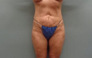 Before & After Pictures in Nashville, TN