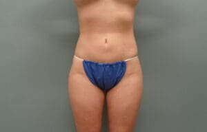 Before & After Pictures in Nashville, TN